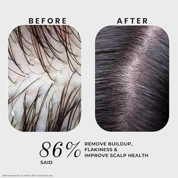 K C Scalp Detox & Hair Treatment Mask - Deep Conditioner for Dry Scalp & Damaged Hair – Scalp Care for Buildup, Flakes & Oil Control – All Hair/Scalp Types – Spa Grade Formula (MEN)