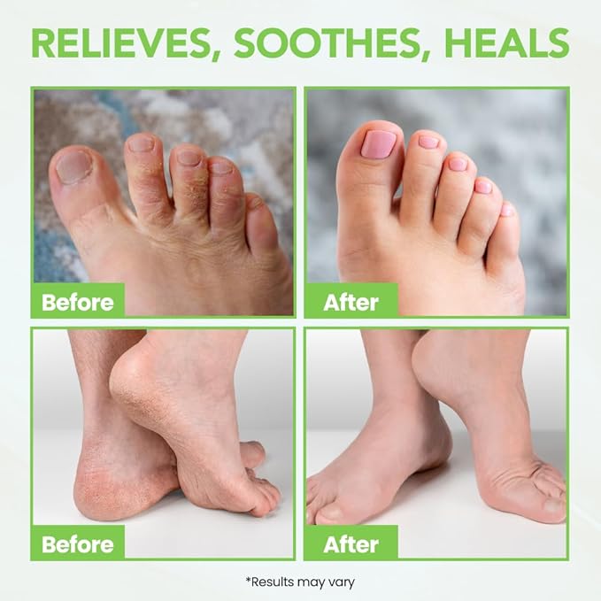 THENA Athletes Foot Treatment Balm, Extra Strength Power6 Formula Foot Cream with Tea Tree Peppermint Neem, Repairs Dry Cracked Feet Heels Itchy Skin Nails Toenails, Advanced Foot Care for Men Women