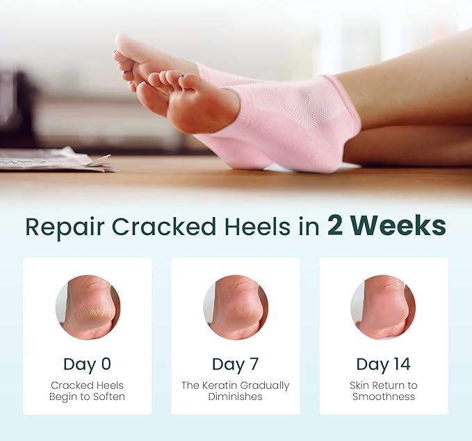 Moisturizing Heel Socks for Cracked Heel Treatment - Promifun 2 Pairs Moisturizer Socks - Heel Socks for Dry Cracked Feet - Cracked Heel Repair - Heel Socks for Women & Men (Pink)