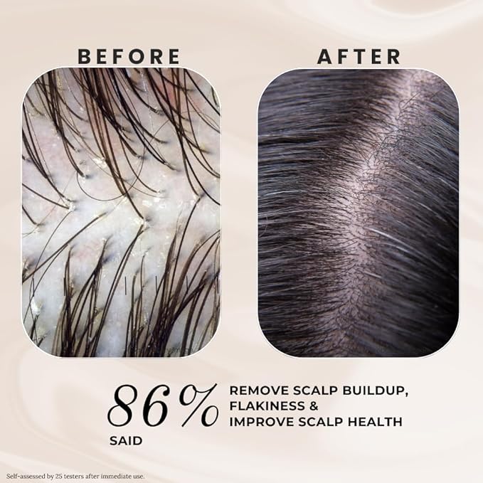 K C Scalp Detox & Hair Treatment Mask - Deep Conditioner for Dry Scalp & Damaged Hair – Scalp Care for Buildup, Flakes & Oil Control – All Hair/Scalp Types – Spa Grade Formula (WOMEN)