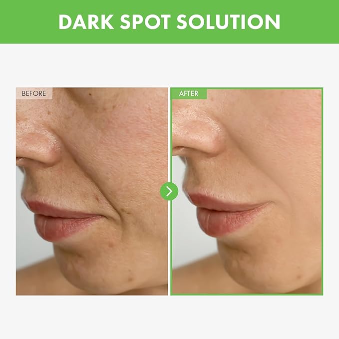 Kakadu Plum Blemish Cream, Dark Spot Remover for Face Cream, Kakadu Plum 600,000ppm, Niacinamide, Adenosine, Betaine, Dark Spot Corrector, Vitamin C, Korean Skin Care, 50g, 1.76 oz.