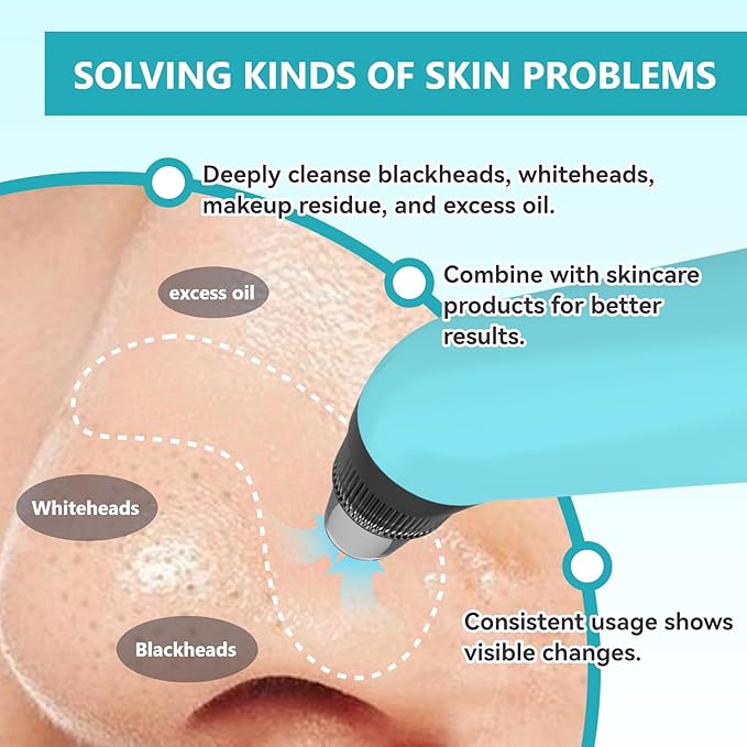 Blackhead Remover Vacuum - Black Head Remover for Face,Blackhead Extractor Tool with 3 Adjustable Suction Levels,4 Probes,USB Interface Type Pore Vacuum,Suitable for Women and Men (Blue)