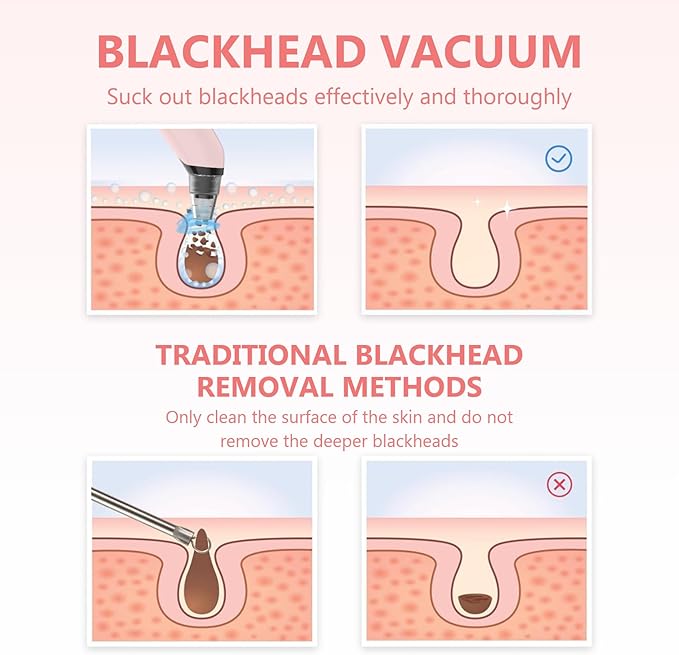 Blackhead Remover Vacuum - Black Head Remover for Face,Blackhead Extractor Tool with 3 Adjustable Suction Levels,4 Probes,USB Interface Type Pore Vacuum,Suitable for Women and Men (Pink)