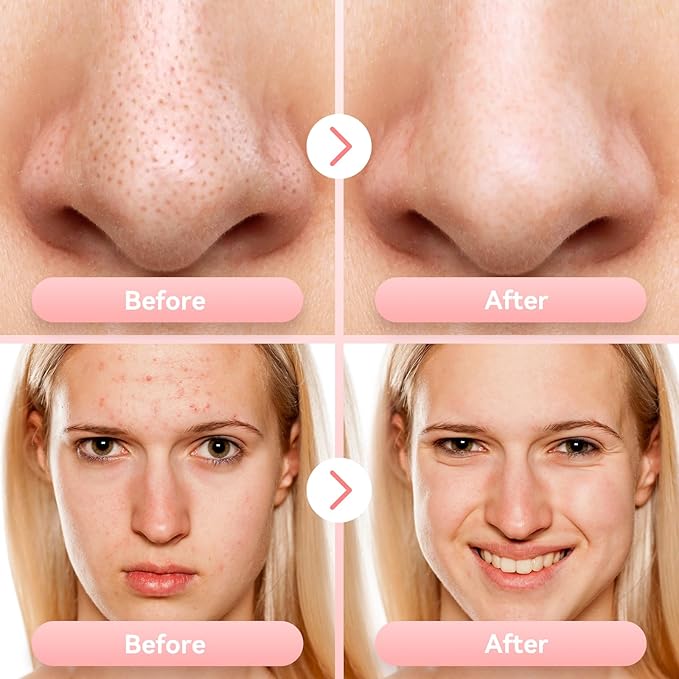 Blackhead Remover Pore Vacuum Upgraded Facial Pore Cleaner Electric Comedone Whitehead Extractor Tool-5 Suction Power,5 Probes,USB Rechargeable Blackhead Vacuum Kit for Women & Men