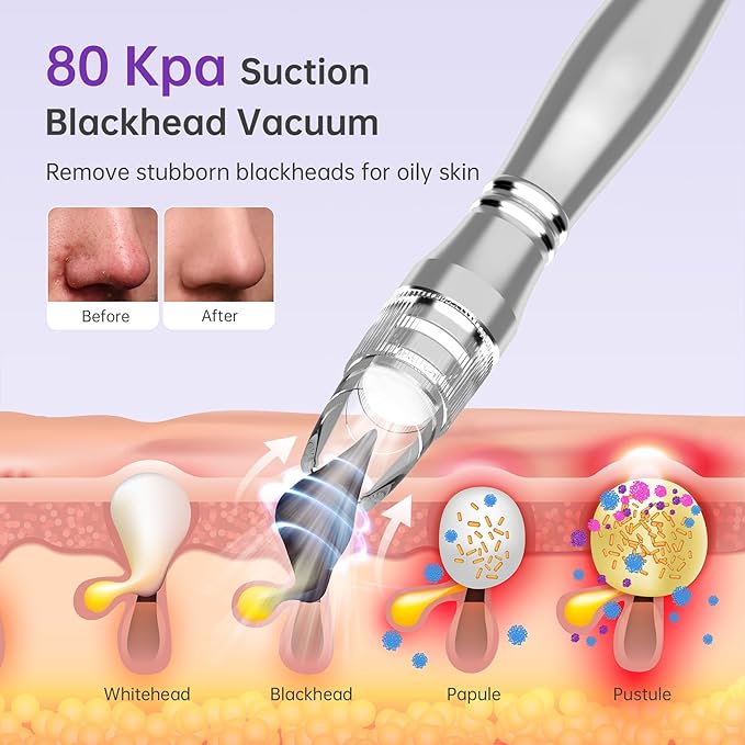 Blackhead Vacuum Removers, 2 in 1 Pro-Grade at-Home Spa Facial Vacuum Pore Cleaner for Blackheads, Whiteheads, Exfoliation, 20-80 Kpa Adjustable Suction for All Skin Types, White