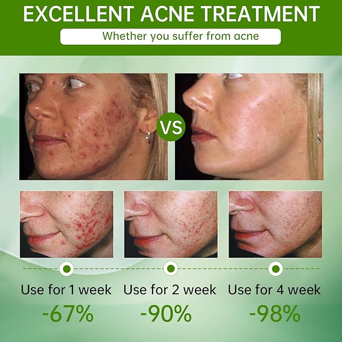 SheDiary Natural Aloe Vera Face Cream for Acne-Prone Skin - Plant-Based Formula to Hydrate, Firm, and Brighten Dull & Aging Skin 30ml