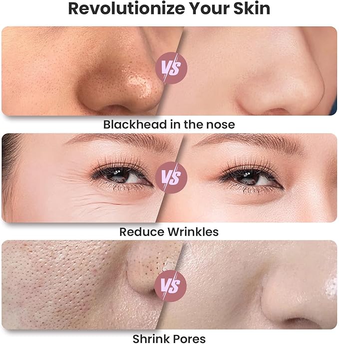 Diamond Microdermabrasion Machine, Portable Blackhead Remover Pore Vacuum, Dermabrasion Facial Machine for Exfoliation & Blackhead Removal
