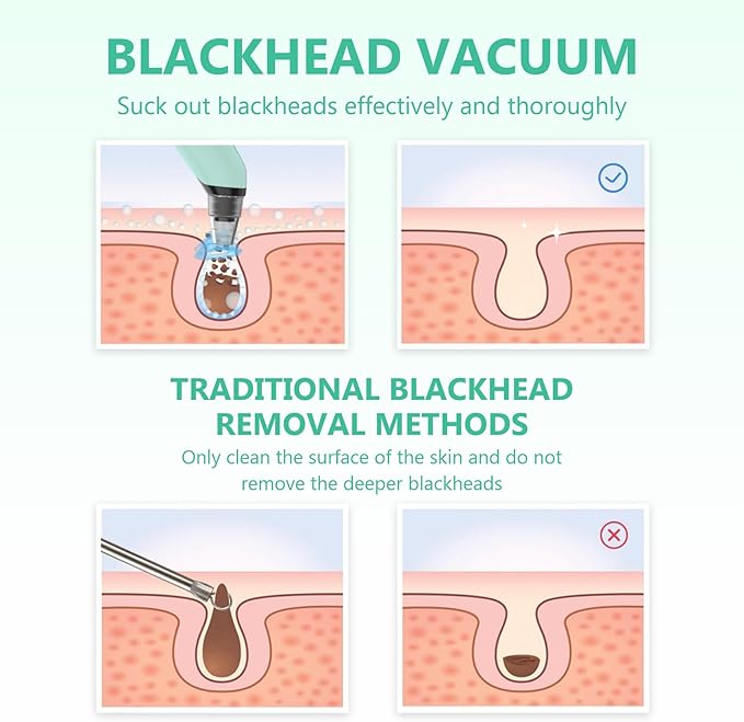 Blackhead Remover Vacuum - Black Head Remover for Face,Blackhead Extractor Tool with 3 Adjustable Suction Levels,4 Probes,USB Interface Type Pore Vacuum,Suitable for Women and Men (Green)