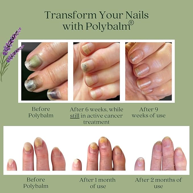 – CLINICALLY PROVEN Nail Protection | 100% NATURAL | Doctor Developed | Strengthen & Repair Nails Damaged by Chemo, Manicures & Aging | Antioxidant, Anti-Fungal & Anti-Inflammatory Properties