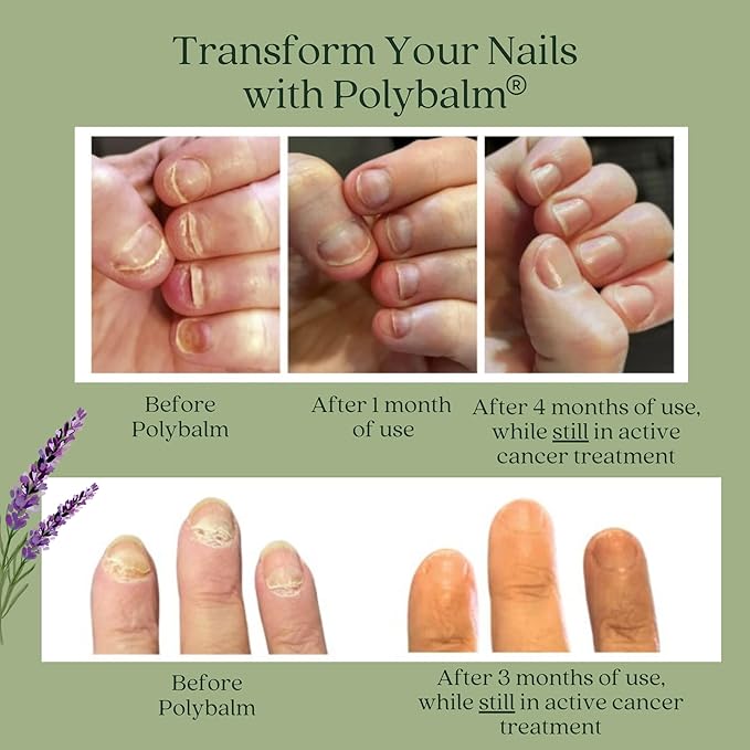 – CLINICALLY PROVEN Nail Protection | 100% NATURAL | Doctor Developed | Strengthen & Repair Nails Damaged by Chemo, Manicures & Aging | Antioxidant, Anti-Fungal & Anti-Inflammatory Properties