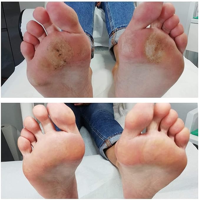 2 in 1 Foot Cream for Dry Cracked Heels - XL Foot Repair Cream for Dry Feet - Suitable for Diabetics - Used by Professionals