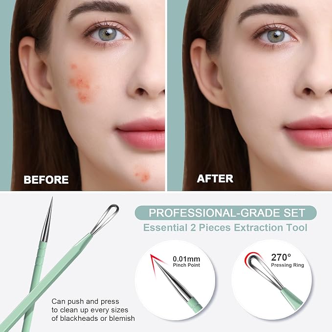 Teenitor Pimple Extractor Acne Treatment Surgical Grade Blackhead Comedone Removal 2-in-1 Popper Tool for Face Nose (Green)