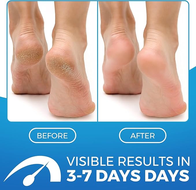2 in 1 Foot Cream for Dry Cracked Heels - XL Foot Repair Cream for Dry Feet - Suitable for Diabetics - Used by Professionals